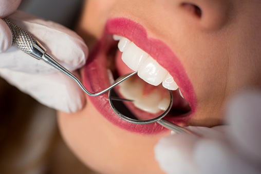 Close up of young woman having dental check up in dental office in Covington, WA.