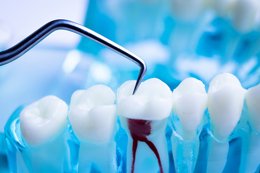 A model of teeth cleaning with titanium metal tooth pick instrument at Peak Endodontics in Covington, WA