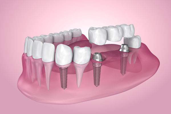 3D rendering of mouth with multiple dental implants at Peak Endodontics in Covington, WA